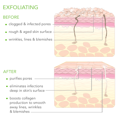 diagram on exfoliated skin